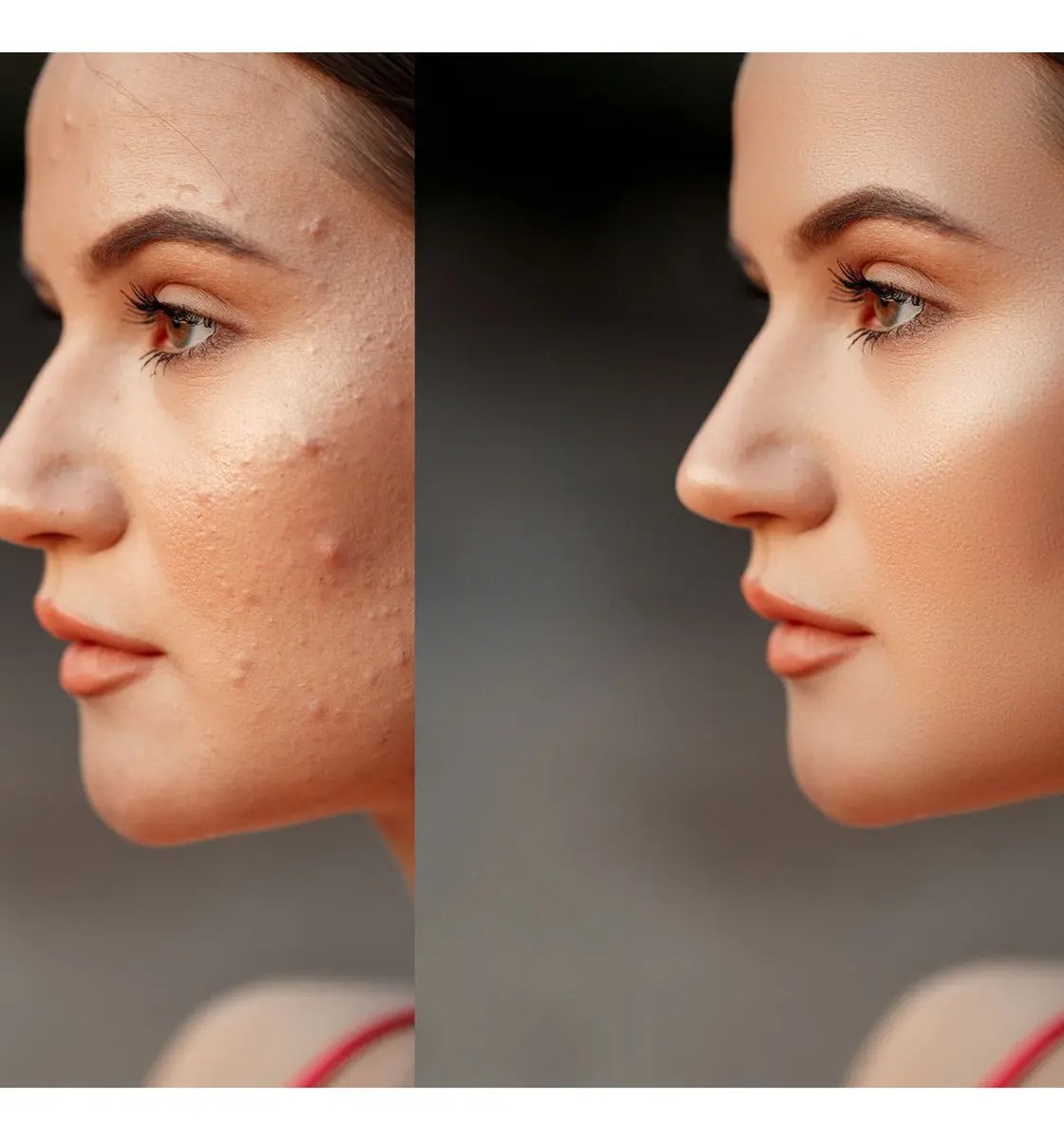 Gel Facial Secativo para acne inflamada Hidramais