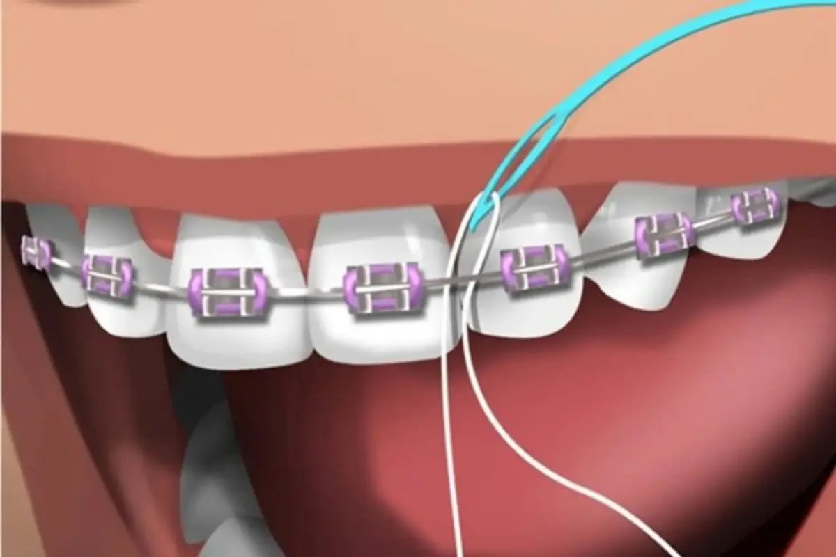 Passa Fio Dental Ortodôntico Predent 30 Unidades